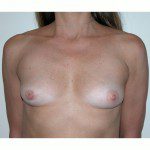 Breast Augmentation 32 Before Photo - 10