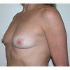 Breast Augmentation 32 Before Photo Thumbnail