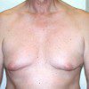 Gynaecomastia 1 Before Photo Thumbnail