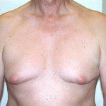 Gynaecomastia 1 Before Photo - 4