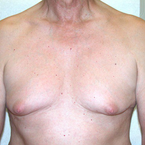 Gynaecomastia 1 Before Photo 