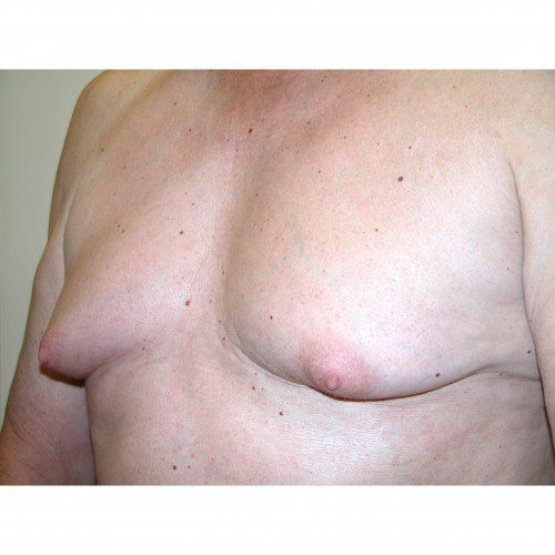 Gynaecomastia 1 Before Photo