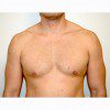 Gynaecomastia 2 After Photo Thumbnail