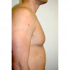 Gynaecomastia 2 After Photo Thumbnail