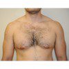 Gynaecomastia 2 Before Photo Thumbnail