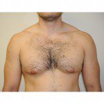 Gynaecomastia 2 Before Photo - 3