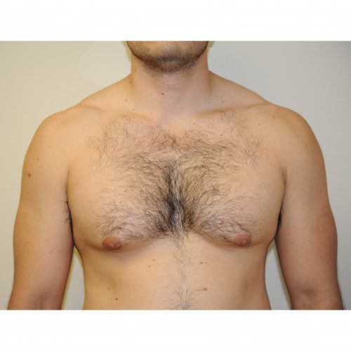 Gynaecomastia 2 Before Photo 