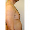 Gynaecomastia 2 Before Photo Thumbnail