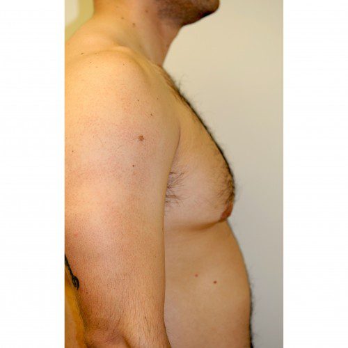 Gynaecomastia 2 Before Photo