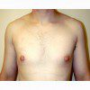 Gynaecomastia 3 After Photo Thumbnail