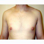 Gynaecomastia 3 After Photo - 9