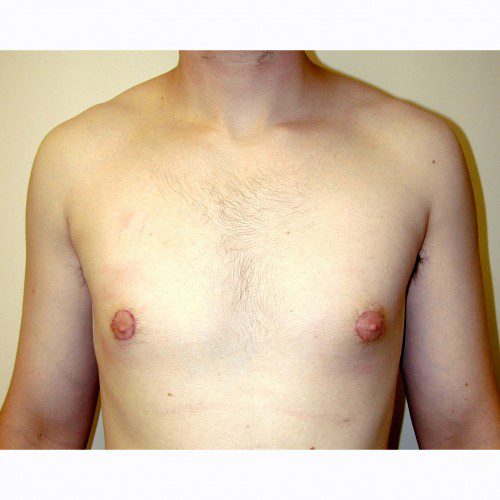 Gynaecomastia 3 After Photo 