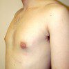 Gynaecomastia 3 After Photo Thumbnail