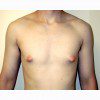 Gynaecomastia 3 Before Photo Thumbnail