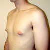 Gynaecomastia 3 Before Photo Thumbnail