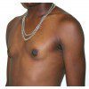 Gynaecomastia 4 After Photo Thumbnail