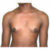 Gynaecomastia 4 Before Photo Thumbnail