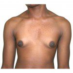 Gynaecomastia 4 Before Photo - 8