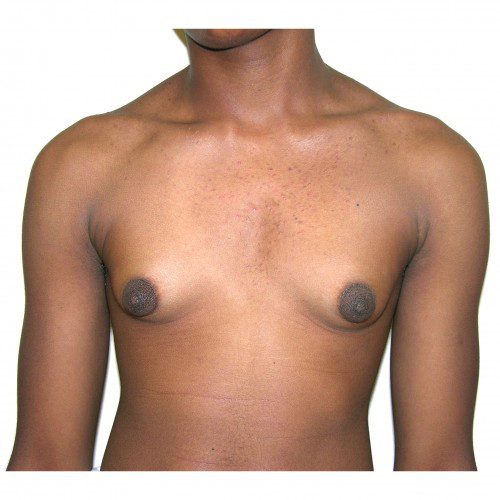 Gynaecomastia 4 Before Photo 