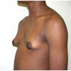 Gynaecomastia 4 Before Photo Thumbnail