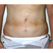 Liposuction 012