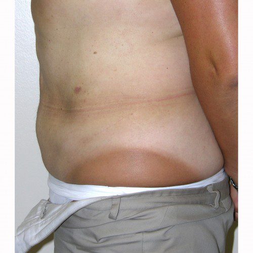 Liposuction 012 After Photo