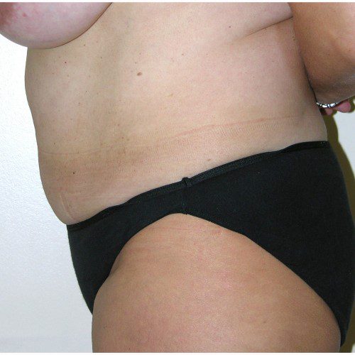 Liposuction 012 Before Photo
