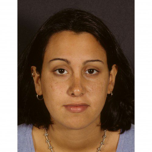 Rhinoplasty 901 After Photo 