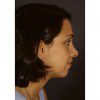 Rhinoplasty 901 After Photo Thumbnail