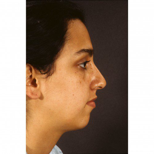 Rhinoplasty 901 Before Photo