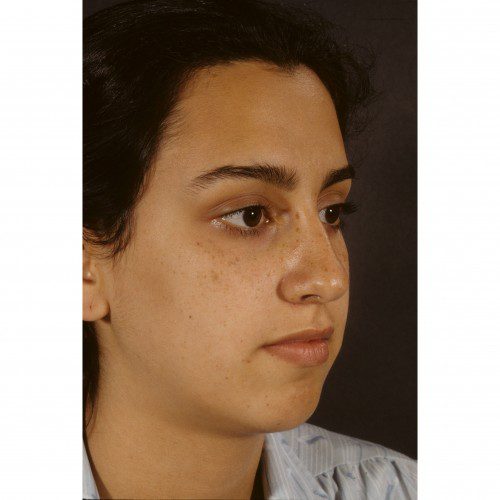 Rhinoplasty 901 Before Photo