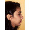 Rhinoplasty 902 After Photo Thumbnail