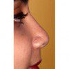 Rhinoplasty 902 After Photo Thumbnail