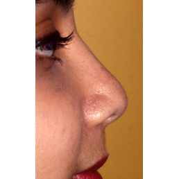 Rhinoplasty 902 After Photo