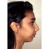 Rhinoplasty 902 Before Photo Thumbnail