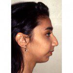 Rhinoplasty 902 Before Photo - 7