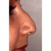 Rhinoplasty 902 Before Photo Thumbnail