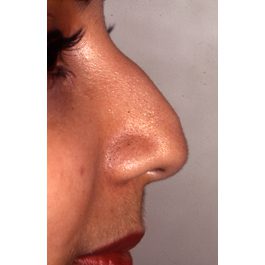 Rhinoplasty 902 Before Photo