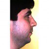 Rhinoplasty 903 After Photo Thumbnail