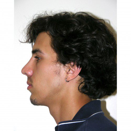 Rhinoplasty 900 After Photo