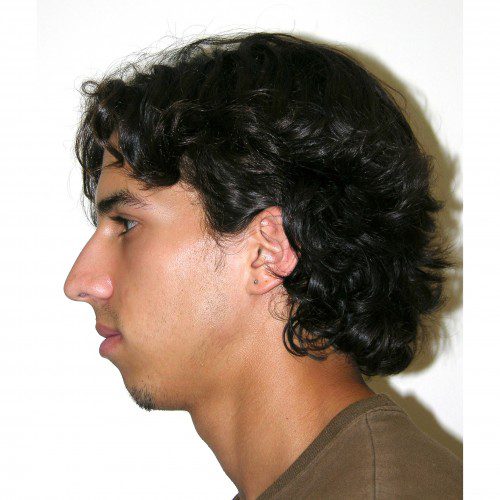 Rhinoplasty 900 Before Photo