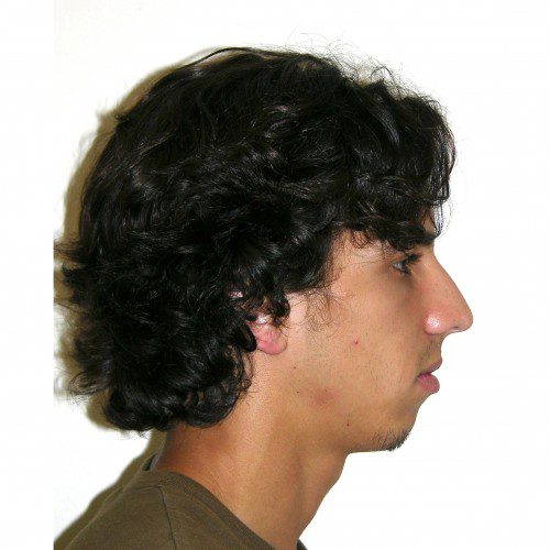 Rhinoplasty 900 Before Photo