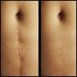 scar revision