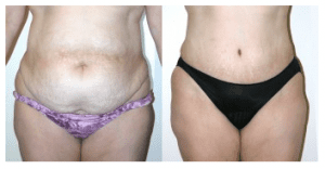 Sex After a Tummy Tuck