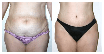 10 Ways a Tummy Tuck Can Change Your Life