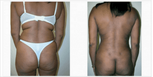 Before and After Back Liposuction