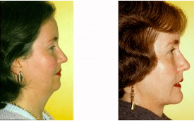 Before and After Chin Liposuction