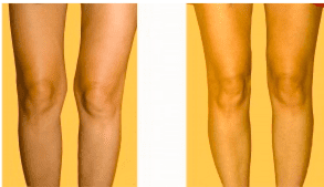 Before and After Knee Liposuction