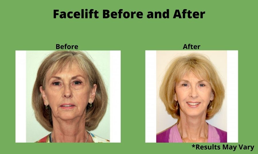 Before and after image showing the results of a facelift performed in Palos Verdes