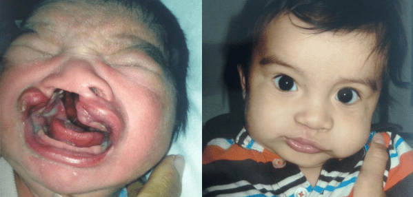 Cleft Lip and Palate Repair Before and After Photos